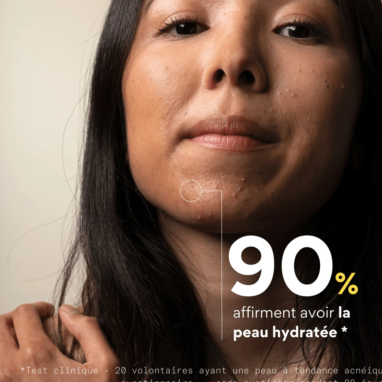 Crème Hydratante Anti-Acné